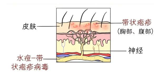 没伤口却疼得像针扎 揭秘皮肤突发刺痛的常见诱因